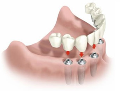 Implantes dentários sem cortes | Blanca Odontologia - Brasília/DF