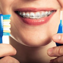 Como limpar os dentes com aparelho